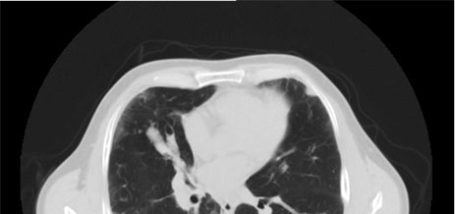 Image for Chest CT Tag