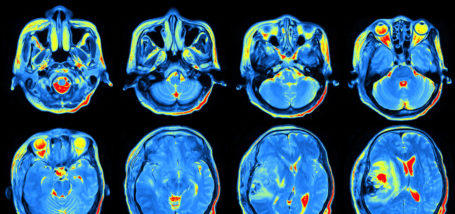 Image for Article: Amyvid PET Helps Clinical Decision Making in Dementia