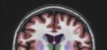 Thumbnail Image: Imaging for New Alzheimer’s Drug Aduhelm